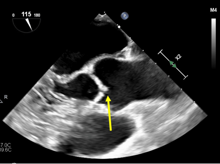 Lambl’s Excrescence and Management of Recurrent Cerebrovascular ...