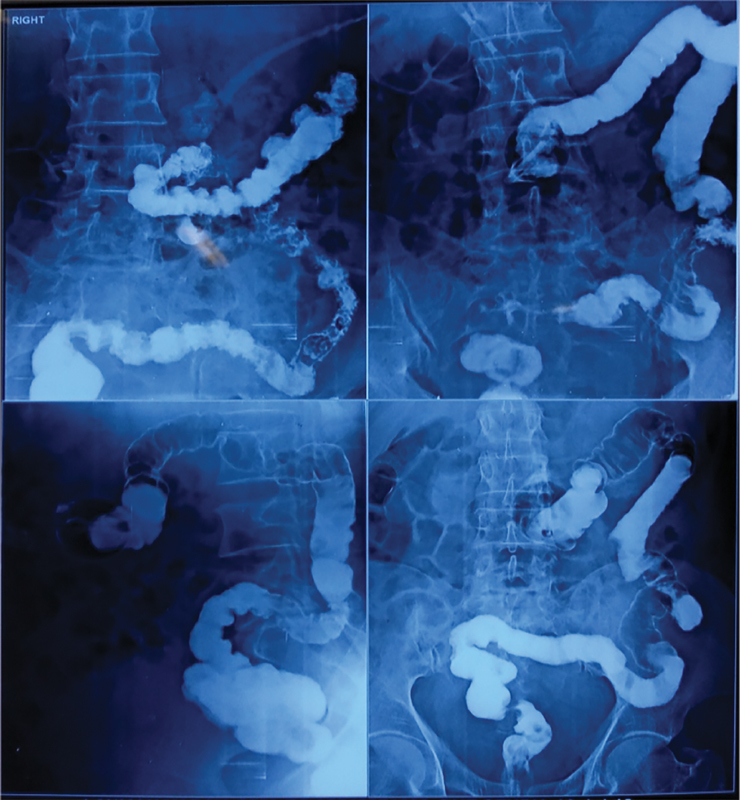 Treatment of Colocutaneous Fistula in the Left Thigh - PMC