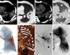 Images in a 63-year-old male patient in the emergency department due to
massive hemoptysis and a history of treated tuberculosis. CT angiographic images (A,
non–contrast material–enhanced axial; B, minimum intensity projection;
C, contrast-enhanced axial in soft-tissue reconstruction; D, contrast-enhanced axial
in lung reconstruction; E and F, three-dimensional reconstructions) show an opacity
with spontaneously hyperdense content (* in A, nonenhanced image) in the left
upper lobe superior lingular segment, compatible with hematoma, associated with
multiple locules of air, as seen in B. The administration of the contrast medium
revealed a 2.1-cm well-circumscribed aneurysm (white arrow in C, E, and F). D,
Multiple small ground-glass centrilobular nodules (white arrowheads) are seen around
the hematoma (*), likely related to endobronchial blood dissemination. G and
H, Images from pulmonary arteriography reveal the aneurysm (black arrow) originating
from branches of the left upper lobe superior lingular artery with active bleeding
(black arrowheads). Selective catheterization was performed, followed by coil
embolization. * indicates the hematoma in all images.