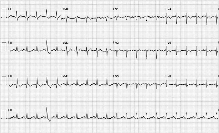 S1Q3T3 pattern leading to early diagnosis of pulmonary embolism - PMC