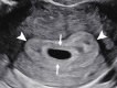Double decidual sac sign. Transvaginal transverse grayscale US image
in a 27-year-old pregnant patient at 5 weeks 3 days shows two concentric
echogenic rings around an oval fluid collection representing the double
decidual sac sign. The inner echogenic ring (arrows) corresponds to
trophoblastic chorion and decidua capsularis. The outer echogenic ring
(arrowheads) represents decidua vera and endometrial lining. The double
decidual sac sign is more specific for an intrauterine pregnancy than the
intradecidual sign when the gestational sac is empty.