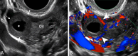 Corpus luteum. (A) Transvaginal sagittal grayscale and (B) color
Doppler US image in a 31-year-old pregnant patient shows a round,
hypoechoic, thick-walled structure (dotted arrow) with a central cystic
space (*) and peripheral vascularity (arrowheads), characteristic of
a corpus luteum. This corpus luteum arises in an exophytic fashion from the
right ovary (OV), which can mimic a tubal ring of ectopic pregnancy. A
helpful feature to diagnose a corpus luteum is a claw sign (solid arrows) of
partially surrounding ovarian parenchyma, which confirms an ovarian
origin.