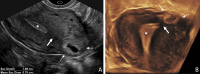 Interstitial ectopic pregnancy (EP). (A) Transvaginal transverse
grayscale and (B) coronal reformatted three-dimensional US image in a
29-year-old pregnant patient shows a gestational sac (GS) (calipers) at 5
weeks 3 days. There is intervening myometrium (solid arrow) between the GS
and endometrium (*). A claw sign (dotted arrows) of myometrial tissue
confirms the pregnancy is implanted in the interstitial (intramyometrial)
segment of the tube, termed an interstitial EP. The term ‘cornual
EP’ should be avoided. Coronal reformatted three-dimensional US may
better demonstrate an interstitial EP separate from the endometrium, as in
this case. Diam = diameter.