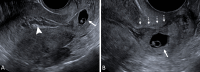 Cervical ectopic pregnancy (EP). (A) Transvaginal sagittal grayscale
US of the uterus and (B) high-resolution US image of the cervix in a
31-year-old pregnant patient at 6 weeks 3 days with vaginal bleeding. A
gestational sac (GS) (solid arrow) is seen containing an embryo with cardiac
activity (not shown) implanted in the cervix. Mixed-echogenicity material
(arrowhead) representing blood products expands the endometrial cavity. The
location of the GS eccentric to the endocervical canal (dotted arrows) and
cardiac activity help make the diagnosis of a cervical EP. The term
‘cervical pregnancy’ should be avoided.