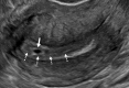 Intradecidual sign. Transvaginal sagittal grayscale US image in a
34-year-old pregnant patient shows a 4-mm empty gestational sac (GS) (solid
arrow) in the anterior endometrium. The location of the GS to one side of
the central hyperechoic line (dotted arrows) representing the opposed
innermost layers of decidualized endometrium confirms it is within
endometrium and not the endometrial cavity, hence the name intradecidual
sign. This sign is helpful when seen to diagnose a probable intrauterine
pregnancy (IUP) before visualization of the yolk sac. Three days later, the
yolk sac was visualized (not shown), allowing for the diagnosis of a
definite IUP.