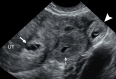 Heterotopic pregnancy. Transvaginal transverse grayscale US image in a
27-year-old pregnant patient shows an early intrauterine pregnancy (IUP)
(solid arrow) containing a yolk sac and a tubal ring of ectopic pregnancy
(EP) (arrowhead) also containing a yolk sac. The coexistence of an IUP and
EP is termed heterotopic pregnancy. The left ovary contains a corpus luteum
(dotted arrow) and is seen in the center. The rim of chorionic tissue in the
IUP and EP is hyperechoic, whereas in contrast, the corpus luteum is
hypoechoic. Echogenicity can help distinguish a tubal ring from a corpus
luteum in some cases. UT = uterus.