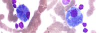 Sea blue histiocytes in bone marrow aspirate