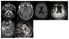 Brain MRI images of Patient-2 with adult NPC