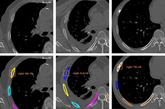 Detection and segmentation examples shown on CT images. The first row images are sections cropped from the raw CT images, and the second row images are the corresponding results from the deep learning model, with colored outlines indicating the different ribs. The first two columns successfully detected rib fractures, while the last column is a false-positive finding.