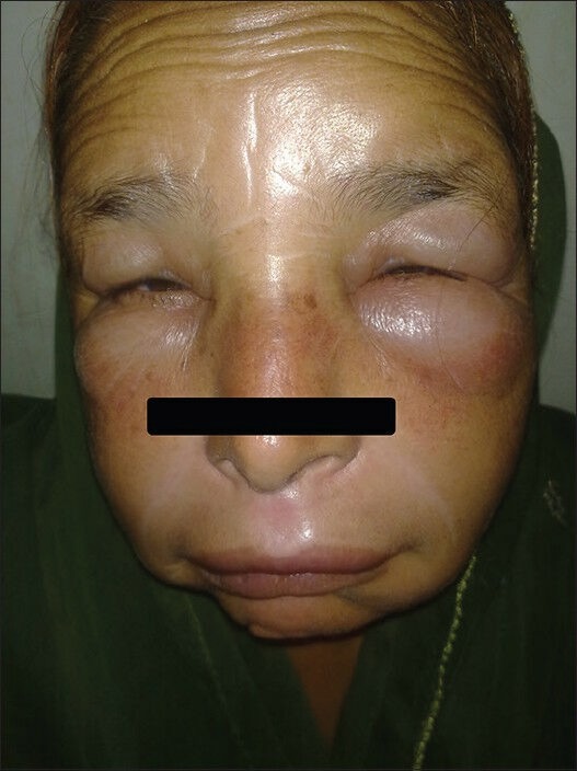 Angioedema due to fixed dose combination of telmisartan plus ramipril - PMC