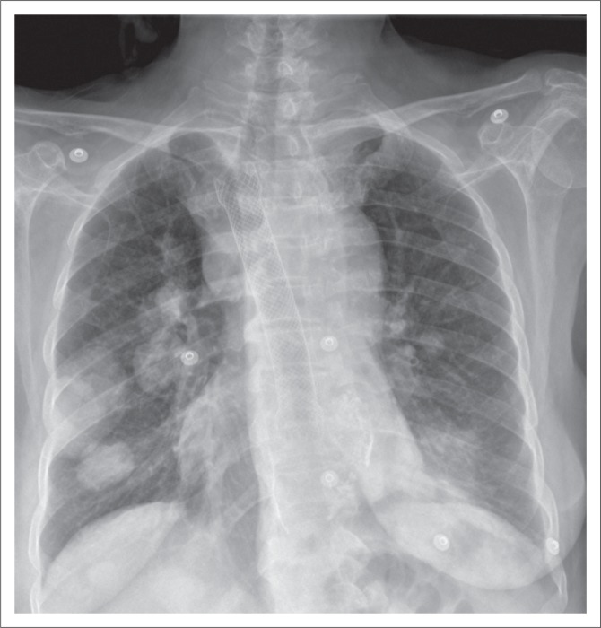 Chest radiographs of cardiac devices (Part 1): Lines, tubes, non ...