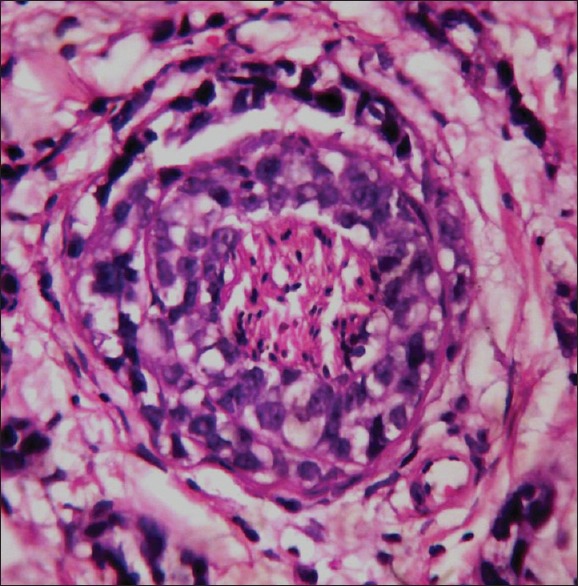 What Cause Bone Tumor