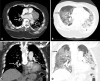 A, B, Axial and, C, D, coronal pulmonary CT angiography images in a 76-year-old African American man with body mass index of 37 kg/m2 who required admission to medical intensive care unit for acute respiratory failure secondary to coronavirus disease 2019 confirmed with reverse transcriptase polymerase chain reaction. Pulmonary CT angiography was obtained 4 days after admission and demonstrates acute pulmonary embolism in right lower lobar pulmonary artery (white arrows), bilateral ground glass opacities (black arrows), and consolidation (arrowheads).