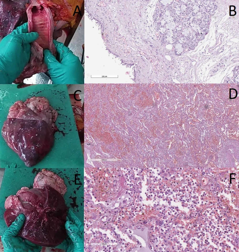 Acute Necrotizing Encephalitis in Viral Respiratory Tract Infection: An ...