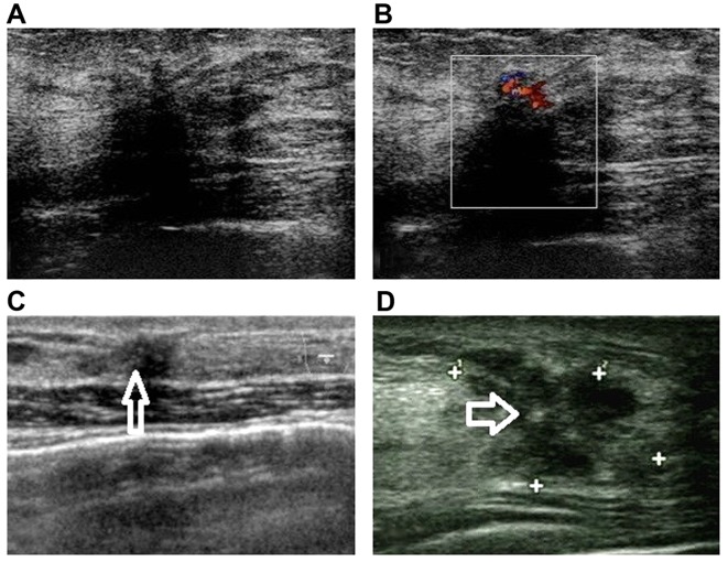 Sclerosing adenosis: Ultrasonographic and mammographic findings and ...