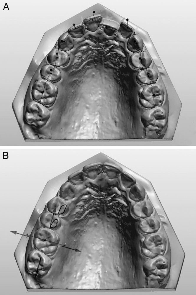 Figure 1. (A) Maxillary model preparation process. (B) Image depicting teeth manipulation.