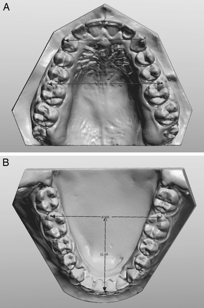 Figure 2. (A) Intercanine and intermolar widths of the maxillary arch. (B) Length of the mandibular arch.