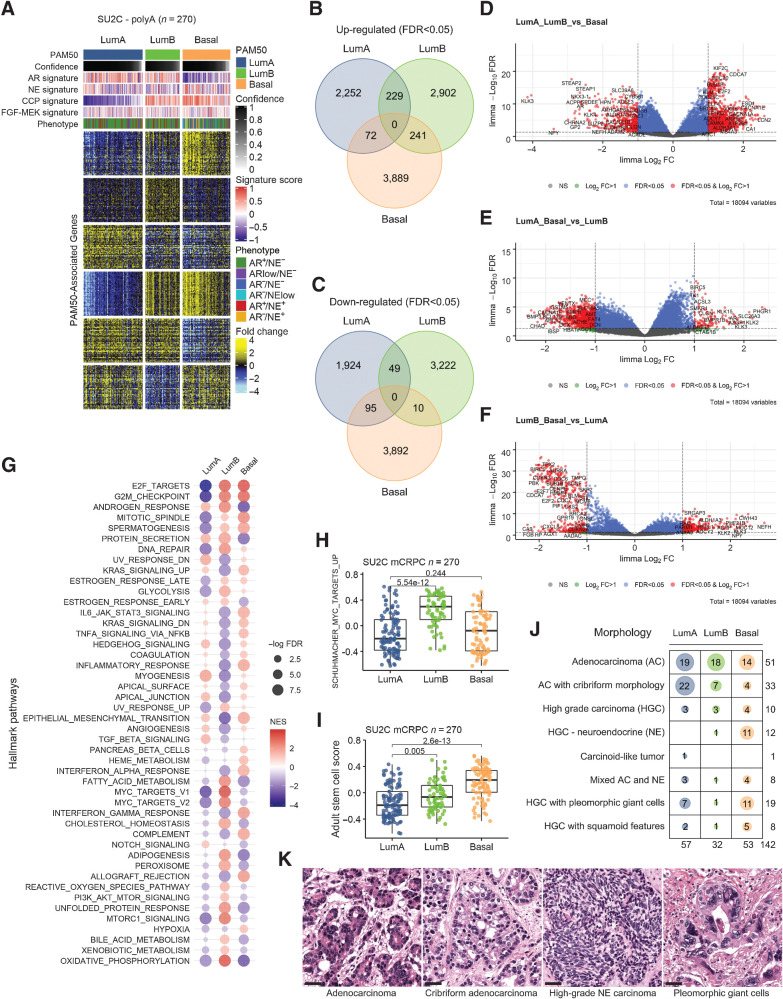 Figure 2. PAM50 classification of metastatic prostate cancers associates with distinct molecular pathways and tumor histology. A, Heatmap of gene expression differences between PAM50 subtypes of mCRPC tumors determined by RNAseq. Fold difference scale reflects mean-centered log2 FPKM values from RNAseq. PAM50 output confidence score for classification is shown in black/gray. Molecular signature scores and phenotypes shown at the top of plot and colored according to leg-ends at the right side. B, Venn diagram of transcripts differentially increased in each PAM50 subtype relative to others. Shown are transcripts with FDR < 0.05). C, Venn diagram of transcripts differentially decreased in each PAM50 subtype relative to others. Shown are transcripts with FDR < 0.05). D–F, Volcano plots of differentially expressed genes in pairwise PAM50 comparisons. G, Differentially enriched Hallmark Pathways across PAM50 subtypes of mCRPC. H, Enrichment of MYC-target genes in the PAM50 LumB subtype of mCRPC. I, Enrichment of genes comprising an Adult Stem Cell signature in the PAM50 Basal subtype of mCRPC. H and I, Groups compared by Wilcoxon-rank tests with BH-adjusted P values shown on plots. J, PAM50 subtype associations with histological classification of mCRPC tumors determined by hematoxylin and eosin staining and morphology. Number of tumors exhibiting each morphology displayed on plot. K, Micrographs show mCRPC tumors of the rapid autopsy cohort with adenocarcinoma, cribriform adenocarcinoma, high-grade neuroendocrine (NE) and high-grade carcinoma with pleomorphic giant cells morphology; scale bar, 20  μm. AC, adenocarcinoma; HGC, high-grade carcinoma; NE, neuroendocrine carcinoma.