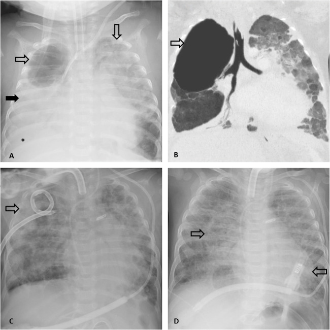 Pneumonia-related pneumatoceles in infants: CT assessment and image ...