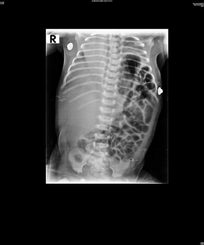 Bilateral congenital eventration of diaphragm: keep in mind, the other ...