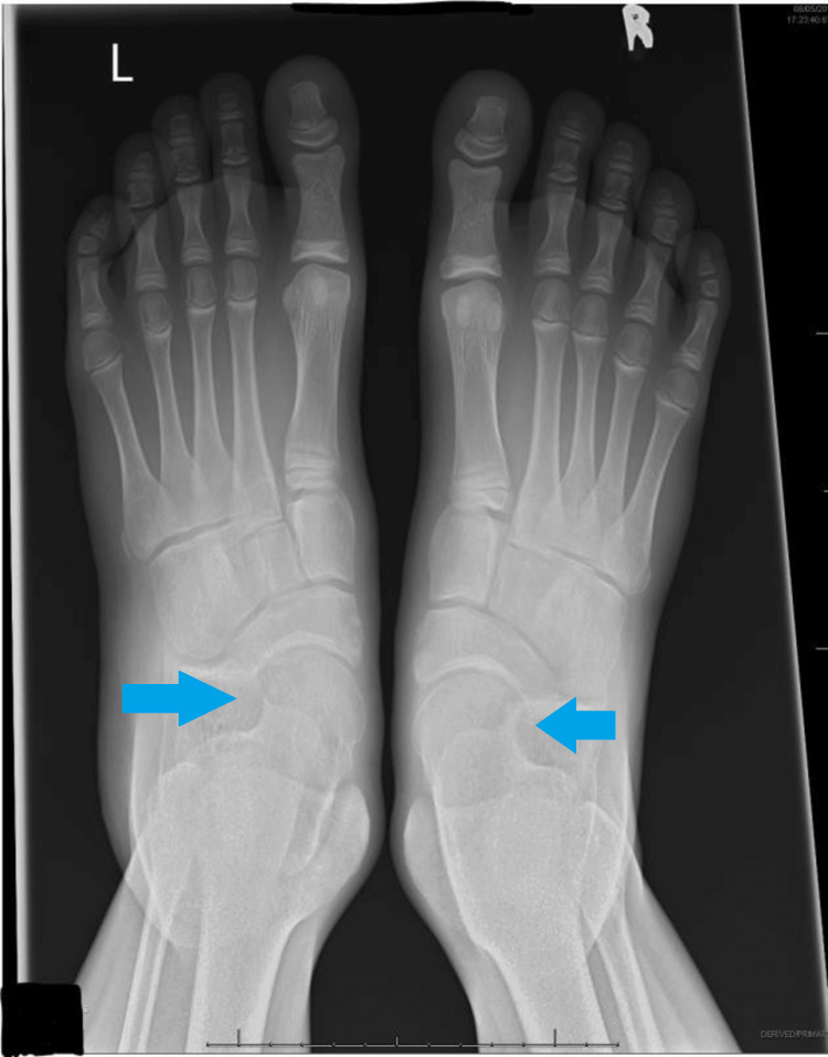 Resection of Bar in the Management of Calcaneonavicular Coalition: A ...