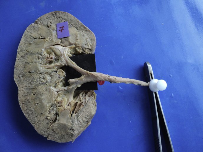 Revisiting the morphology of pelvicalyceal system in human cadaveric ...