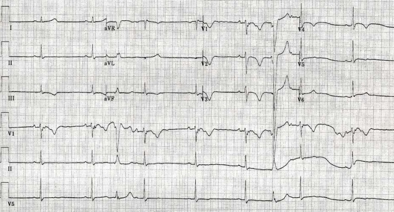 The Electrocardiographic Manifestations of Arrhythmogenic Right ...