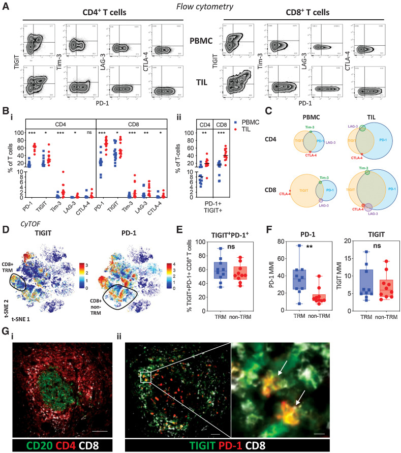 Figure 4. Checkpoint inhibitory receptor expression on PDAC T cells. A, Expression of checkpoint inhibitory receptors PD-1, TIGIT, Tim-3, LAG-3, and CTLA-4 on CD4+ and CD8+ T cells from matched PBMC and TIL was examined by flow cytometry (n = 14). Representative flow cytometric zebra plots show expression of each checkpoint inhibitory receptor alongside PD-1 expression for CD4+ and CD8+ T cells from PBMC and TIL. B, Scatter plots compare the proportion of each checkpoint receptor (i) and dual PD-1 and TIGIT expression (ii) on CD4+ and CD8+ T cells from PBMC and TIL. C, Venn diagrams show the overlapping expression of checkpoint inhibitory receptors on CD4+ and CD8+ T cells from PBMC and TIL. D, t-SNE plot of PDAC TIL CyTOF data first presented in Fig. 2B showing the expression level of TIGIT and PD-1. CD8+ TRM cells are highlighted. E, Box and whisker plot, generated using the CyTOF data first presented in Fig. 2B, compares dual TIGIT and PD-1 expression on TRM and non-TRM CD8+ T cells from PDAC TIL. F, Box and whisker plots, generated using the CyTOF data first presented in Fig. 2B, compare the MMI of PD-1 and TIGIT on TRM and non-TRM CD8+ T cells from PDAC TIL. G, Multiplex IHC staining shows T-cell staining around CD20+ B cells in lymphoid structures (scale bar: 100 μm) (i); expression of PD-1 and TIGIT across the follicle with TIGIT focused within the T-cell zone (scale bar: 50 μm) and PD-1+TIGIT+ coexpression on CD8+ T cells (scale bar: 10 μm) (ii). Horizontal lines represent median, boxes represent quartiles and whiskers represent min and max values. Data analyzed using Wilcoxon matched-pairs signed rank test. *, P < 0.05; **, P < 0.01; ***, P < 0.001.