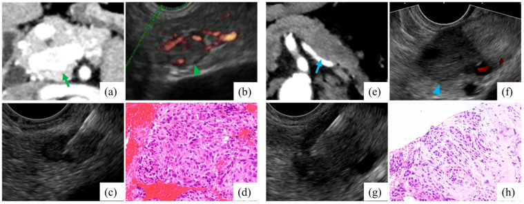 Safety And Diagnostic Yield Of Endoscopic Ultrasound-guided Fine-needle 