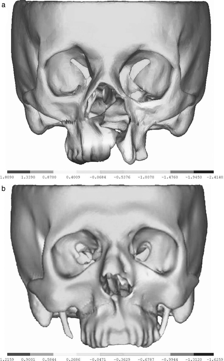 Figure 3. Displacement distribution in the transverse plane after 6 mm of maxillary advancement. (a) for the UCLP model; and (b) for the control model.