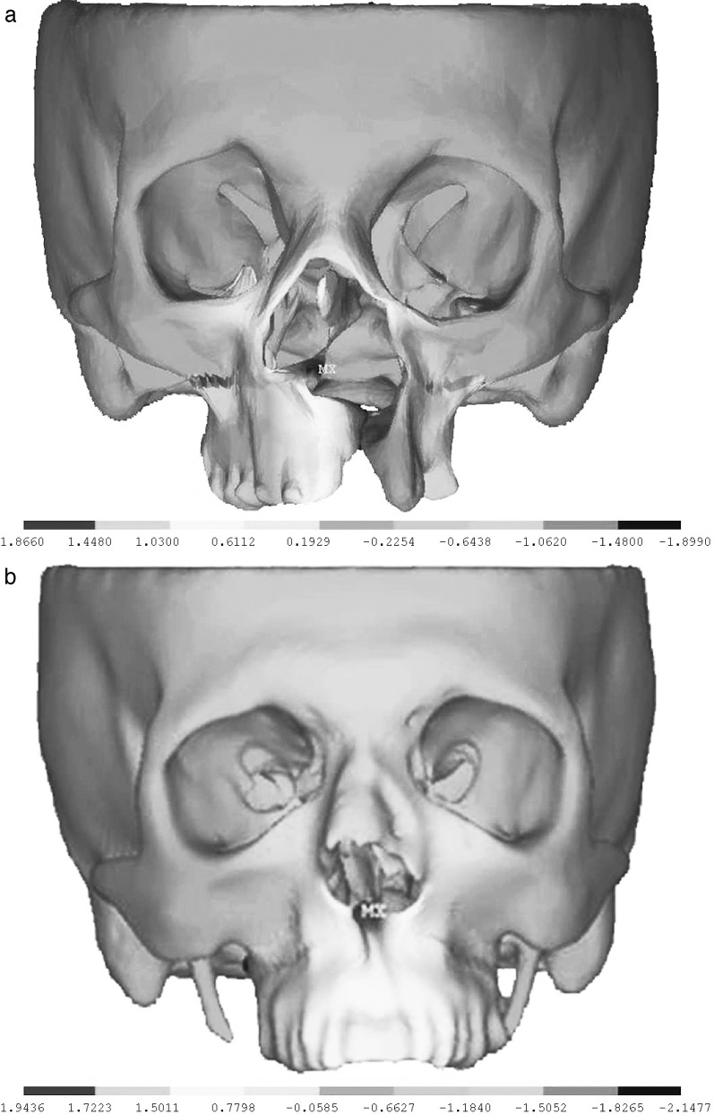 Figure 4. Displacement distribution in the vertical plane after 6 mm of maxillary advancement. (a) for the UCLP model; and (b) for the control model.