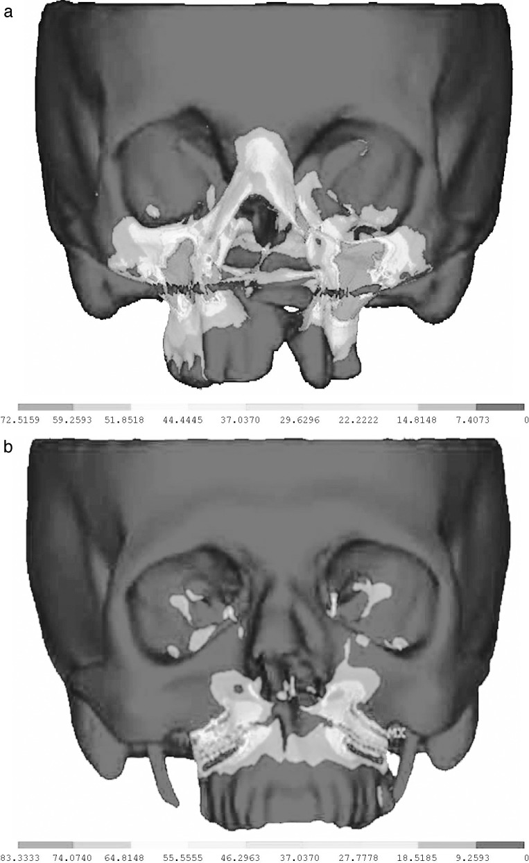 Figure 5. The magnitude and distribution of the von Mises stresses after 1 mm of maxillary advancement. (a) for the UCLP model; and (b) for the control model.