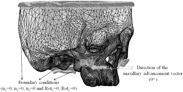 Figure 1. Three-dimensional finite element model of a patient with UCLP. Black arrows represent the boundary conditions at the foramen magnum, the upper side of the cranial vault, and the zygomatic buttress, where the superior plates of the distractor are assumed to be fixed. Red arrows represent the direction of the maxillary advancement vector.