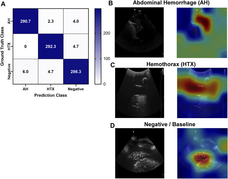 An Extended Focused Assessment With Sonography In Trauma Ultrasound 