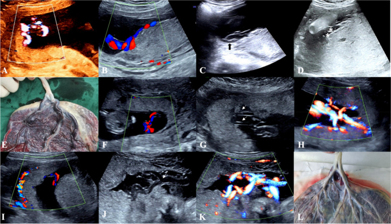 Marginal cord insertion in the first trimester is associated with ...