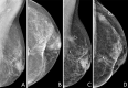 Interval second breast cancer. Surveillance mammograms in a
43-year-old woman obtained 10 years after treatment of primary breast cancer
show negative results. A, Mediolateral oblique and, B, craniocaudal views
show postlumpectomy changes in the upper inner quadrant. C, Mediolateral
oblique and, D, craniocaudal views from diagnostic mammography performed 10
months later show a round mass with indistinct margins in the upper outer
quadrant, deep to a triangular skin marker indicating a new palpable lump. A
high-grade invasive ductal carcinoma with triple-negative receptor status
was subsequently diagnosed in this location.