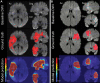 (A) Images in a 60-year-old woman with a National Institutes of Health
Stroke Scale (NIHSS) score of 2 and right M1 segment occlusion exemplify a
large vessel occlusion case. Rapid software identified a hypoperfusion
lesion of 146 mL and a core of 32 mL. The model predicted 201 mL for the
hypoperfusion lesion (as shown in the bottom row), with accurate spatial
location and a Dice score coefficient (DSC) of 0.71. (B) Images in a
40-year-old man with an NIHSS score of 7 and left M2 segment occlusion
exemplify a case without large vessel occlusion. Rapid software identified a
hypoperfusion lesion of 62 mL and a core of 30 mL. The model predicted 103
mL for the hypoperfusion lesion, with accurate spatial location and a DSC of
0.64. Ax = axial, Cor = coronal, DWI = diffusion-weighted imaging, Sag =
sagittal.