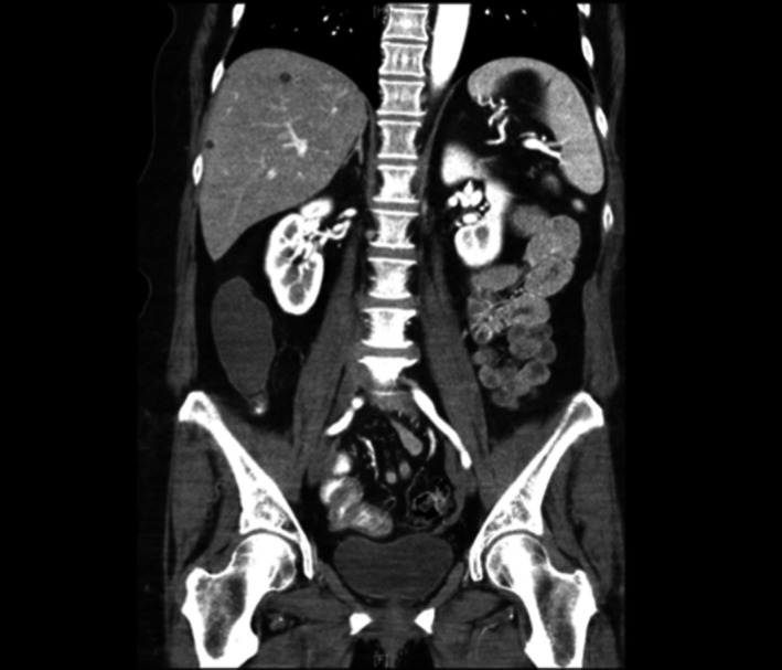 Incidentally Discovered Low‐grade Appendiceal Mucinous Neoplasm: A 