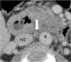 Patient is a 52-year-old woman. Transverse section of 7-mm node (arrow) between aorta (A) and inferior vena cava (IVC), scored as positive based on ill-defined border (true positive).