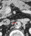 Patient is a 68-year-old woman. Marked differences of minimal node size in the different orthogonal planes: (a) transverse 3.8 mm, (b) sagittal 5.4 mm, and (c) coronal 6.5 mm. Consequently, 4 mm (3.8 rounded to a whole number) was recorded as node size. Node was scored as negative but was a false negative. A = aorta, IVC = inferior vena cava.