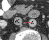 Patient is a 79-year-old man. (a) Transverse, (b) coronal, and (c) sagittal images of aortocaval node, with minimal diameters of 3.4 mm, 3.9 mm, and 6.8 mm, respectively. Consequently, 3 mm (3.4 mm rounded to a whole number) was recorded for node size. Node was scored as negative (true negative).