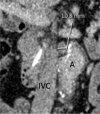 Patient is a 64-year-old man. (a) Transverse and (b) coronal images of node between aorta (A) and inferior vena cava (IVC), with minimal diameter of 11.5 and 10.8 mm, respectively. Because the coronal image yielded the lowest diameter, 11 mm (10.8 rounded to a whole number) was recorded as node size. The node was scored as positive based on size and round shape but was false positive.