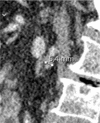 Patient is a 68-year-old woman. Marked differences of minimal node size in the different orthogonal planes: (a) transverse 3.8 mm, (b) sagittal 5.4 mm, and (c) coronal 6.5 mm. Consequently, 4 mm (3.8 rounded to a whole number) was recorded as node size. Node was scored as negative but was a false negative. A = aorta, IVC = inferior vena cava.