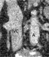 Patient is a 68-year-old woman. Marked differences of minimal node size in the different orthogonal planes: (a) transverse 3.8 mm, (b) sagittal 5.4 mm, and (c) coronal 6.5 mm. Consequently, 4 mm (3.8 rounded to a whole number) was recorded as node size. Node was scored as negative but was a false negative. A = aorta, IVC = inferior vena cava.