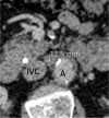 Patient is a 64-year-old man. (a) Transverse and (b) coronal images of node between aorta (A) and inferior vena cava (IVC), with minimal diameter of 11.5 and 10.8 mm, respectively. Because the coronal image yielded the lowest diameter, 11 mm (10.8 rounded to a whole number) was recorded as node size. The node was scored as positive based on size and round shape but was false positive.