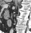 Patient is a 79-year-old man. (a) Transverse, (b) coronal, and (c) sagittal images of aortocaval node, with minimal diameters of 3.4 mm, 3.9 mm, and 6.8 mm, respectively. Consequently, 3 mm (3.4 mm rounded to a whole number) was recorded for node size. Node was scored as negative (true negative).