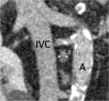 Patient is a 79-year-old man. (a) Transverse, (b) coronal, and (c) sagittal images of aortocaval node, with minimal diameters of 3.4 mm, 3.9 mm, and 6.8 mm, respectively. Consequently, 3 mm (3.4 mm rounded to a whole number) was recorded for node size. Node was scored as negative (true negative).