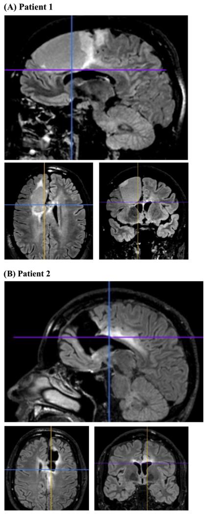 Anterior cingulate cortex and cognitive control: Neuropsychological and ...