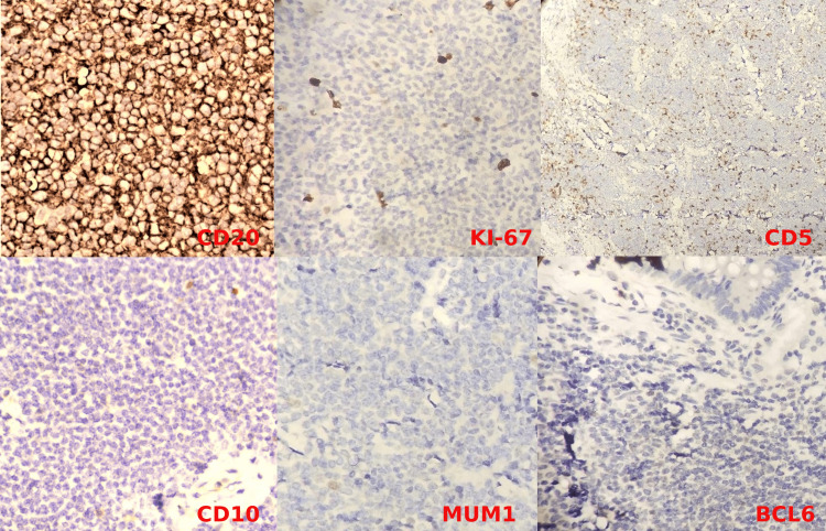 Synchronous Adenocarcinoma Stomach With Marginal Zone Lymphoma: A 