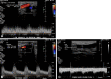 AVG anastomotic stenosis in a dysfunctional AVG in a 44-year-old
woman. (A) Spectral Doppler US image of the right upper arm brachiocephalic
AVG shows a PSV 164 cm/sec in the brachial artery 2 cm cranial to the
arterial anastomosis (upstream). (B) Doppler US image shows an elevated PSV
718 cm/sec at the arterial anastomosis results in a PSV ratio of 4:4,
consistent with that of stenosis (gray-scale image not shown). (C) Doppler
US image shows that the low-flow volume at the venous end of the AVG
measures 465 cc/min.